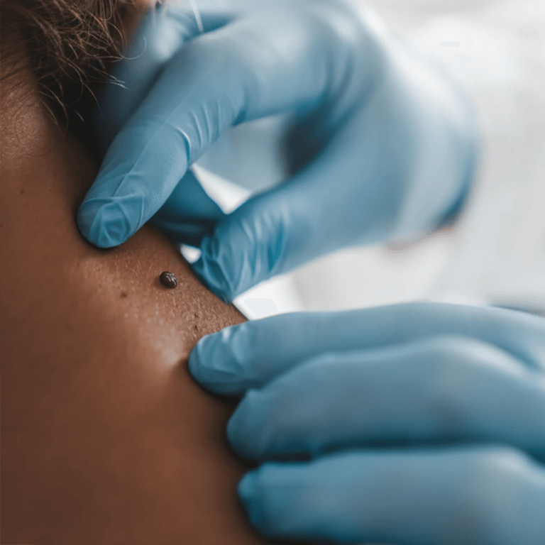 skin tag removal (1)